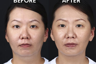 Treatment HIFU TDT Terbaik di Semarang