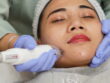 Treatment Fractional Laser Terbaik di Semarang