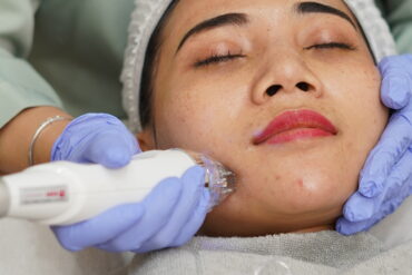 Rekomendasi Treatment yang Bisa Memperindah Bibir